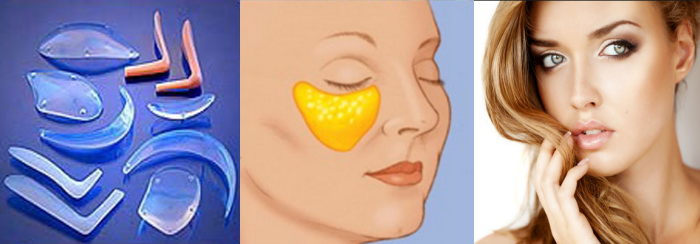 Cheek Augmentation